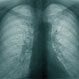 How Long Does Asthmatic Bronchitis Last?
