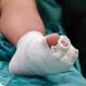 Is Hammer Toe Surgery Painful?