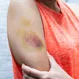 Why Is a Hematoma Worse Than a Bruise?