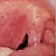 How do you drain a Peritonsillar abscess?