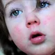 Treatment of Scarlet Fever