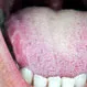 What Does Having a Scalloped Tongue Mean?