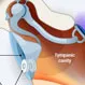 What is Turbinectomy Surgery